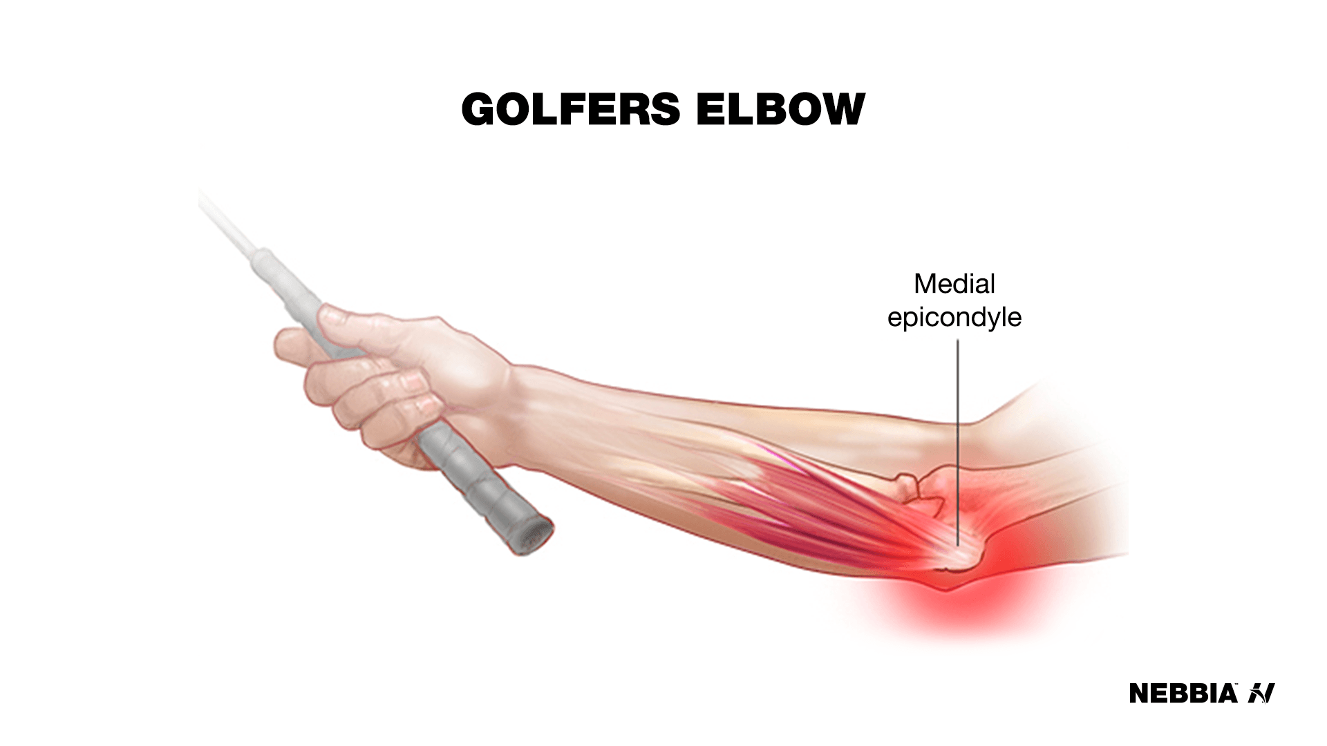 golfers elbow